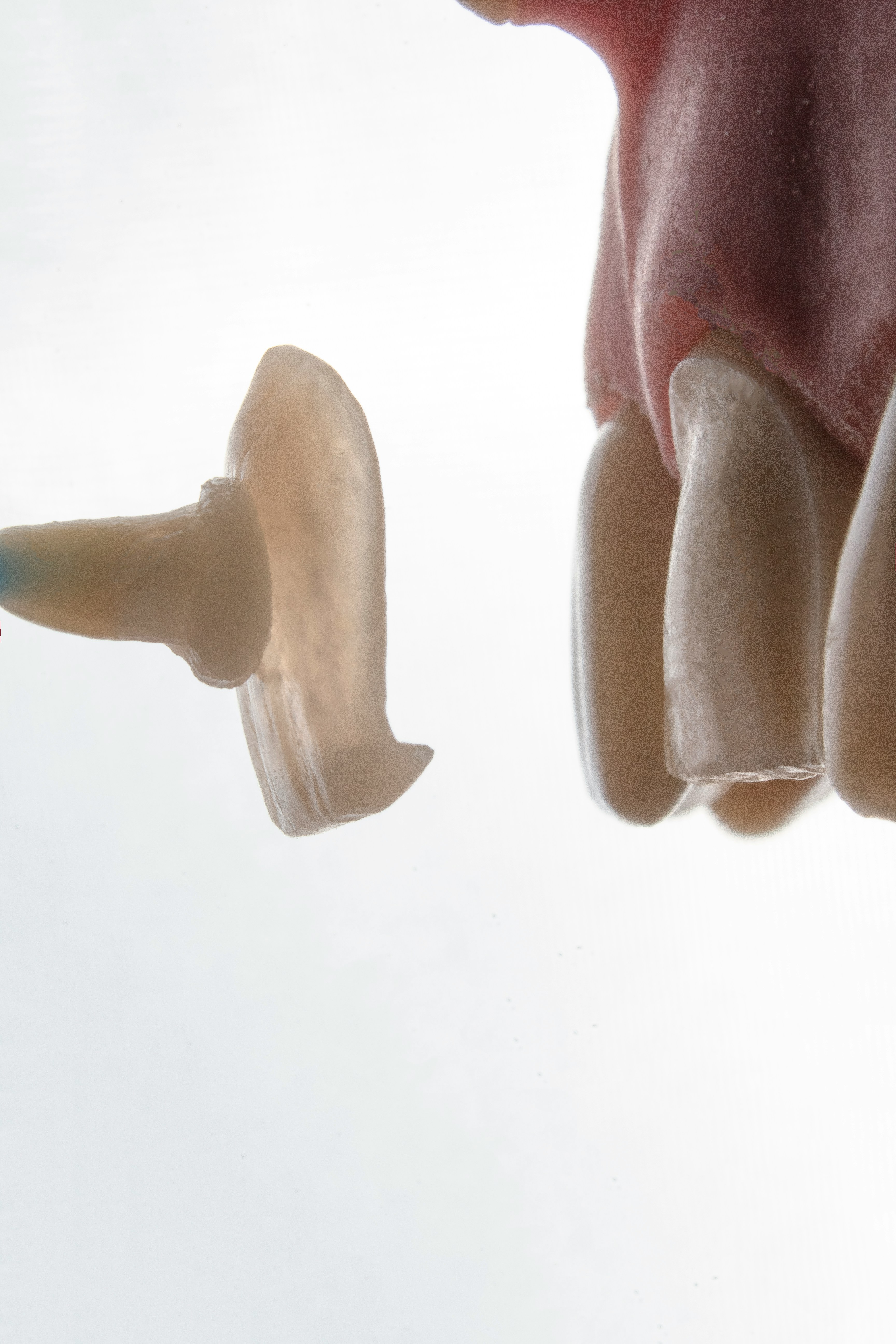 E.MAX Veneers